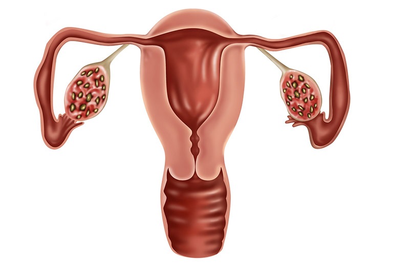 Đau bụng kéo dài – Biểu hiện của u xơ tử cung?